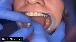 Металлокерамика зубы