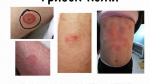 Грибок кожи. Грибок ногтей. #грибоккожи#грибокногтей#подготовкакusmle