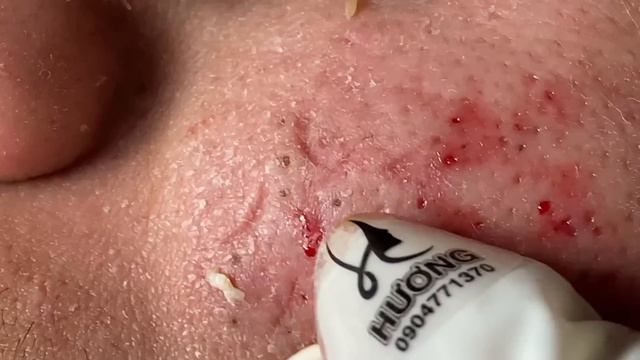 Make Your Acne Treatment Huong Da Nang#496 | Acne 2022 Part2