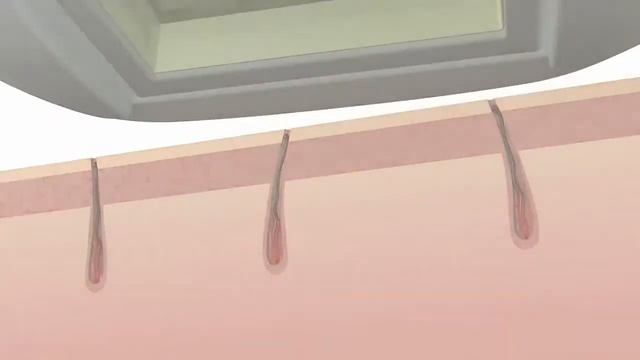 Фотоэпилятор Remington. Домашний фотоэпилятор Remington IPL5000. смотреть онлайн