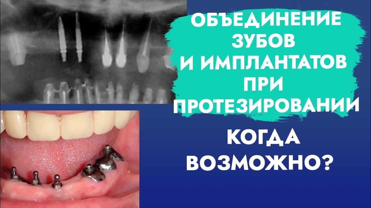 Объединение зубов и имплантатов при протезировании. Когда возможно? смотреть онлайн