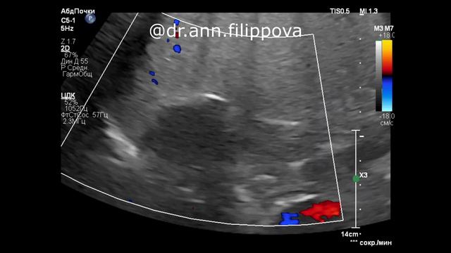 Инциденталома НАДПОЧЕЧНИКА ⚠️ ADRENAL INCIDENTALOMA смотреть онлайн