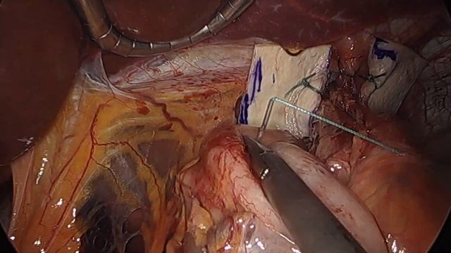 Nissen Fundoplication Animation With Actual Surgical Footage