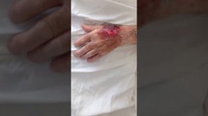 Гнойная хирургия (перевязка)