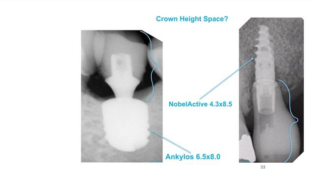 CEREC TiBase Lecture Series Lesson 03 смотреть онлайн