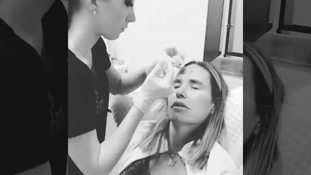 Botox - Watch The Procedure