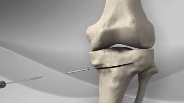 Остеотомія великогомілкової кістки