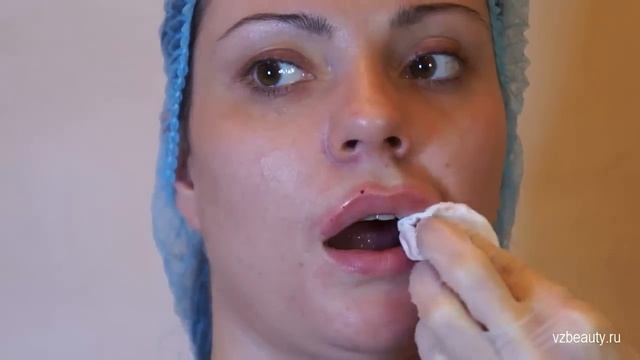 Увеличение губ #10 смотреть онлайн