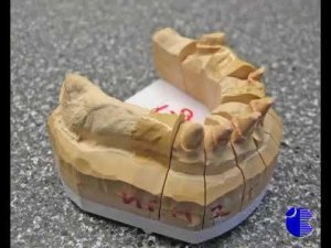 Этапы изготовления бюгельных протезов часть 1