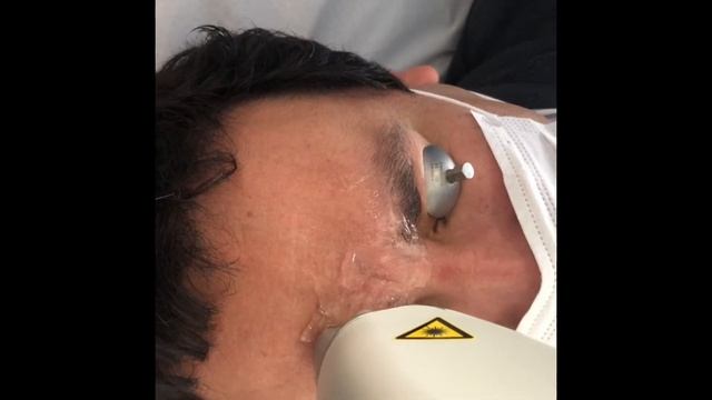 60% de descuento - Depilación entrecejo. Láser soprano Ice смотреть онлайн