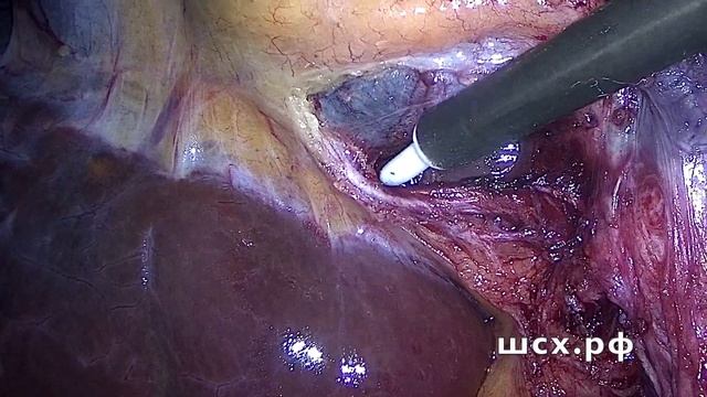 Безопасная холецистэктомия-практикум. смотреть онлайн