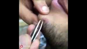 Удаление вросшего волоса