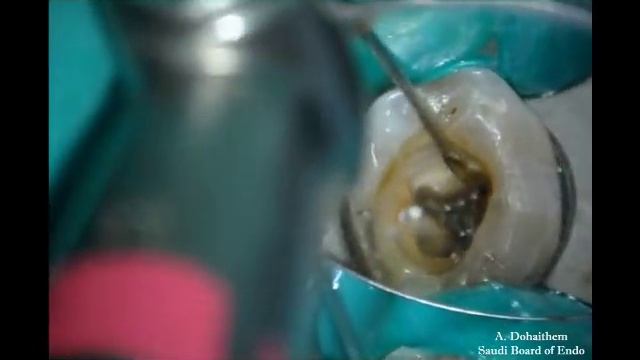 Retreatment #36 Silver Point.flv смотреть онлайн