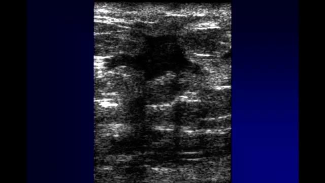 Staging Breast Cancer with Ultrasound смотреть онлайн
