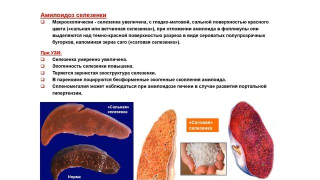Ультразвуковая диагностика (УЗИ). Доктор Иогансен. Выпуск 62. Спленомегалия. Часть 2. смотреть онлайн