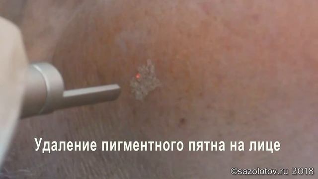 Удаление пигментного пятна на лице СО2 лазером смотреть онлайн