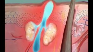 Здоровье с Еленой Малышевой О Лечении Прыщей