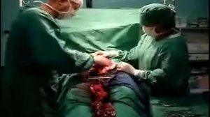 Кесарево сечение