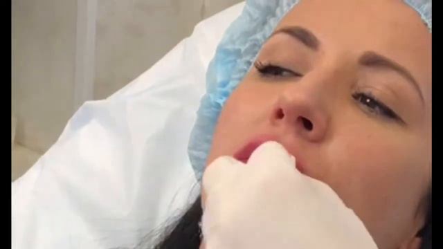 Контурная пластика губ, увеличение губ препаратом Helene Smooth