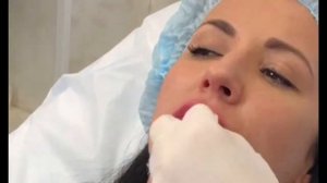 Контурная пластика губ, увеличение губ препаратом Helene Smooth