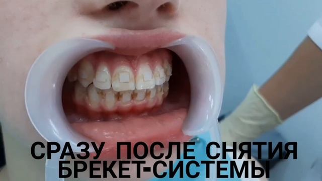 Долгожданный день снятия брекет-системы смотреть онлайн