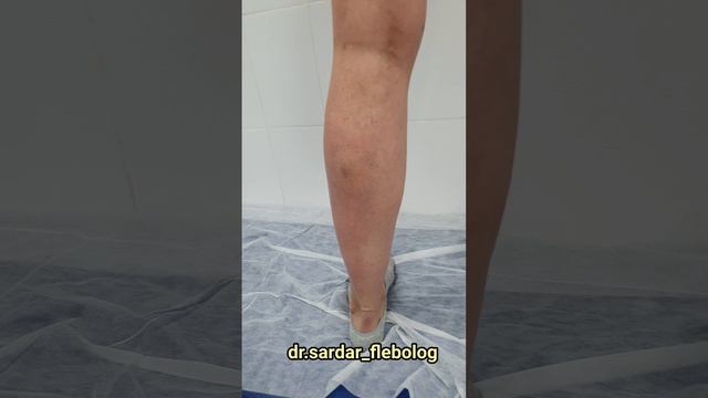 Результат операции лечения варикоза. Флеболог Москва. Флеболог. Сосудистый хирург Москва