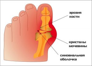 Лечение подагры в домашних условиях