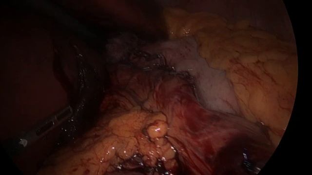 Лапароскопия в "Клинике "Движение" смотреть онлайн