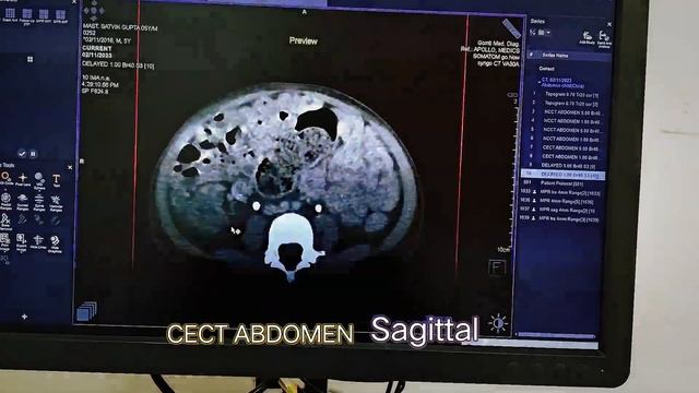 CT Scan af Abdomen, abdomen CT Scan смотреть онлайн