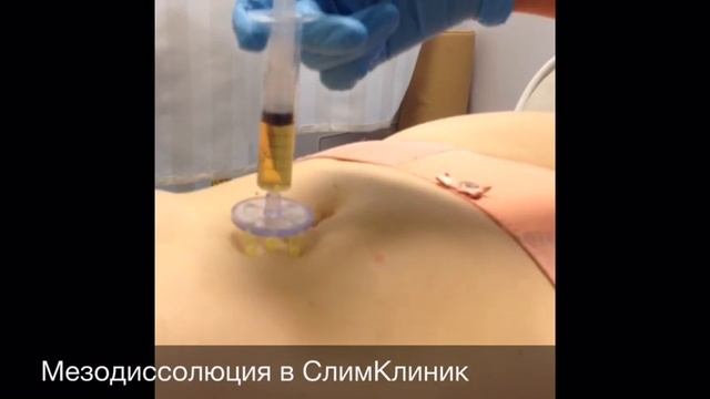 Мезодиссолюция. Сжигание жира в СлимКлиник. смотреть онлайн