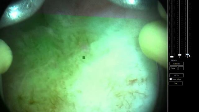 Рак мочевого пузыря. Фотолон.