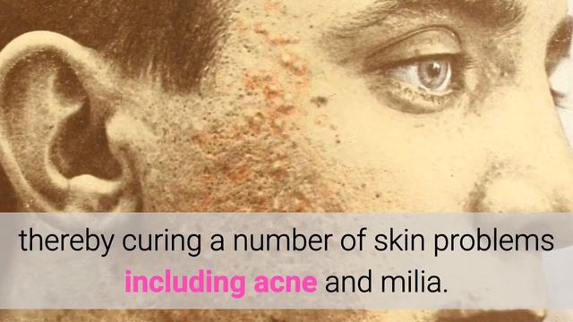 Top 10 Home Remedies For Milia | Milia Treatment смотреть онлайн
