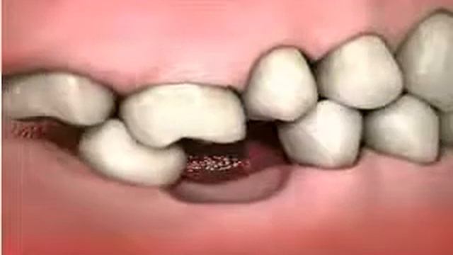 Изменение зубного ряда при потере жевательного зуба смотреть онлайн