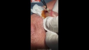 Личинка овода в губе