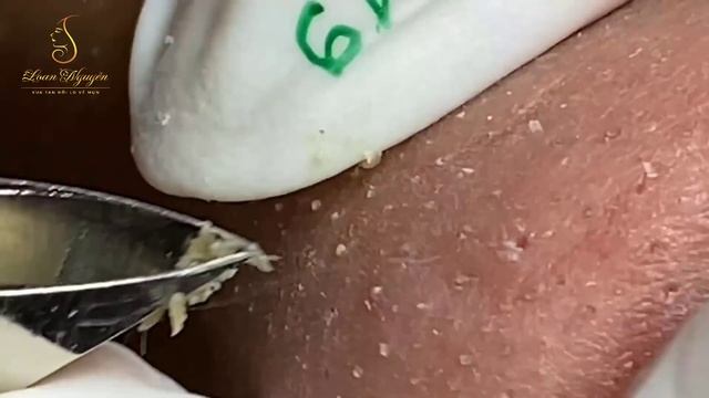 Loan Nguyen Acne Treatment (#152)