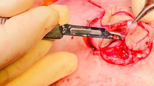 NIPPLE AREOLA COMPLEX RECONSTRUCTION Dr. Marco Bernini смотреть онлайн