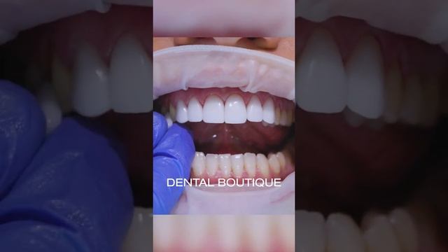 HOW SATISFYING IS THIS VENEERME PORCELAIN VENEERS INSERT?!!?❤️
