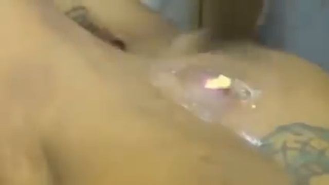 Выдавливание гигантского прыща на спине/Squeezing big pimple смотреть онлайн