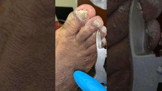 DOUBLE FUNGUS NAIL ATTACK | THICK FUNGAL TOENAILS смотреть онлайн