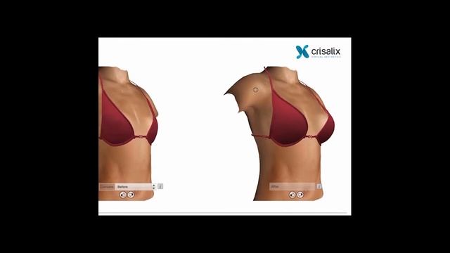 3D-моделирование Crisalix в клинике Эпиона Медикус смотреть онлайн