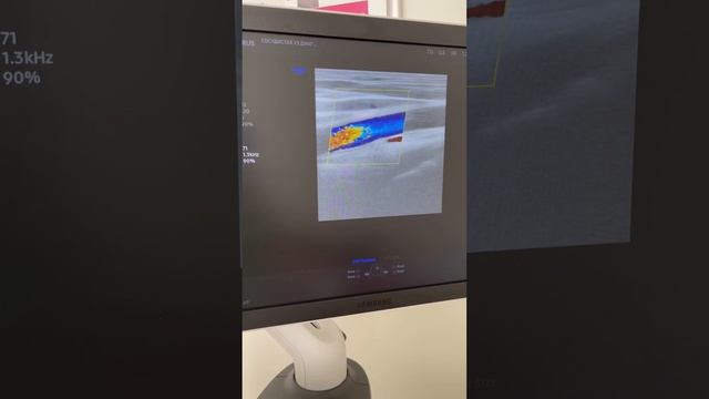 Врачебная ошибка или ? Узи сосудов. Флеболог Москва. Флеболог смотреть онлайн