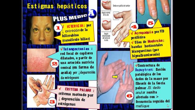 HEPATITIS VIRAL & CIRROSIS смотреть онлайн