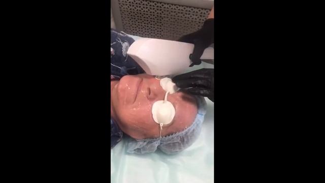 Лазерное омоложение лица смотреть онлайн