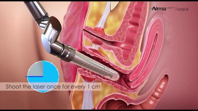 ШайнЭст - FemiLift From Alma Lasers Surgical - How It Works