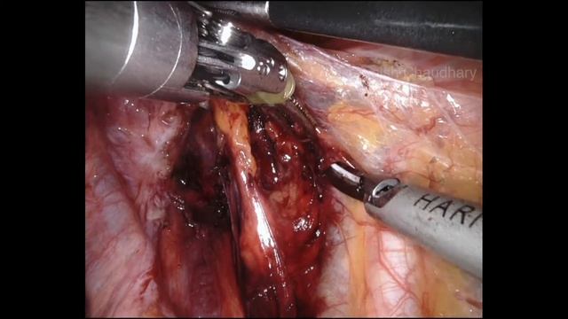 Robotic identification of sentinel lymph node смотреть онлайн