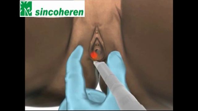 Co2 Fractional laser Virginal Tightening смотреть онлайн
