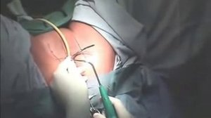 Оперативное лечение недержания мочи у женщин