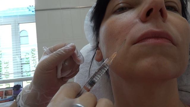 Филлёр Teosyal для носогубок смотреть онлайн