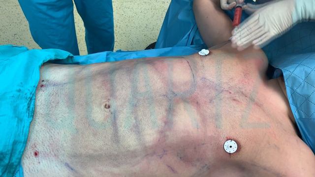 Vaser Liposuction In High Definition With Dr Leyla Arvas | Vaser Hi-Def смотреть онлайн