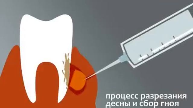 Флюс. Лечение флюса смотреть онлайн